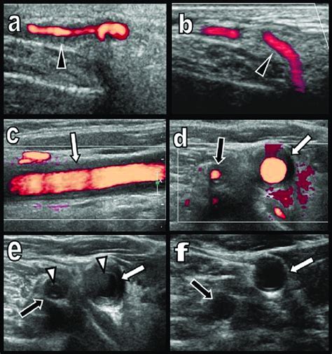 Arterial Doppler Ultrasound