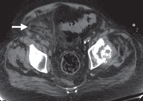 Retroperitoneal Fasciitis Spectrum Of Ct Findings In The Abdomen And Pelvis Radiographics