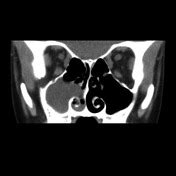 Sinonasal Disease Radiology Reference Article Radiopaedia Org