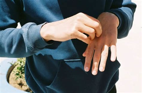 Overcoming Obsessive Skin Picking Disorder With Autism