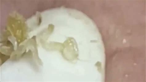 Удаление и выдавливание черных точек. прыщи. акне - YouTube