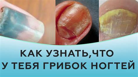 Как выглядит грибок ногтей