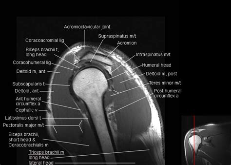 Anatomy Mri Shoulder at Manuela Frasher blog