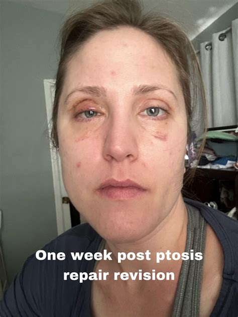 Ptosis Plus Upper Blepharoplasty Rplasticsurgery