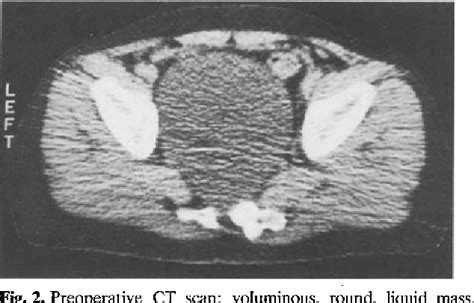 The Management Of Anterior Sacral Meningocele With Computed Tomography