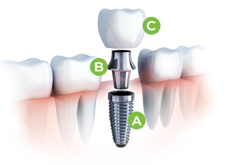 Implantes Dentales En Palma De Mallorca Tsastre