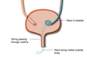 How is a ureteral stent removed?