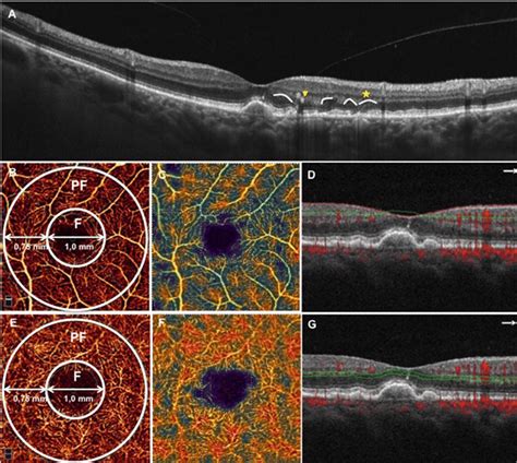 Spectral Domain Optical Coherence Tomography Sd Oct And Optical