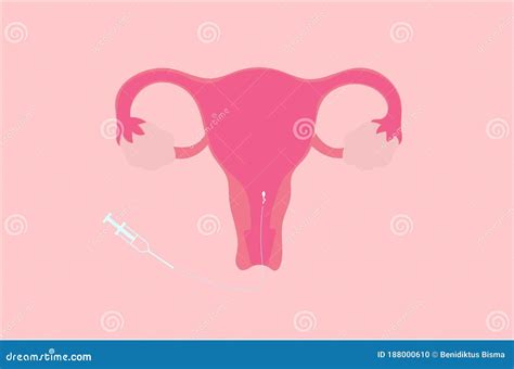 Ilustraci N Vectorial De Inseminaci N Intrauterina Iui Ilustraci N Del