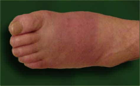 Diabetes Early Stage Feet