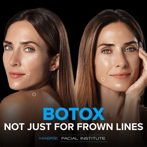 Beyond Wrinkles Discover Surprising Benefits Of Botox® For Trap