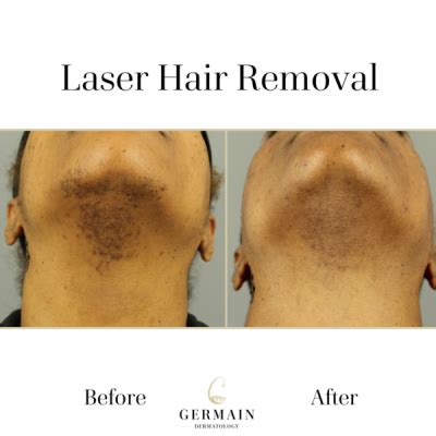 Laser Hair Removal Treatment | Mt Pleasant, at South Carolina