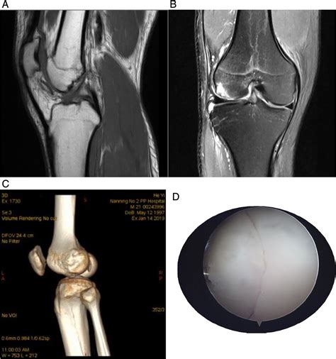 Treatment Of Osteochondral Fracture Of The Lateral Femoral Condyle With