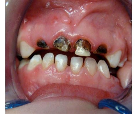 Tooth Decay Difference Between Early Childhood Caries And Rampant