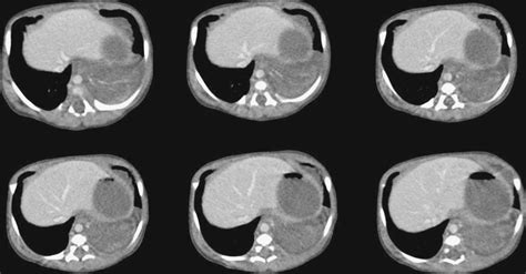 Sequestration Radiology Key