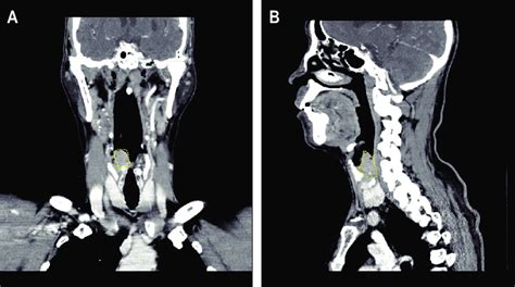 Computed Tomography Images Showing An Example Of Hypopharyngeal