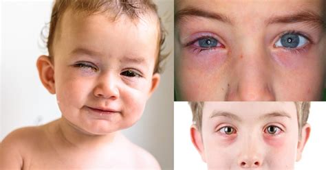 Viral Conjunctivitis: Causes, Symptoms, and Treatment – Shishu