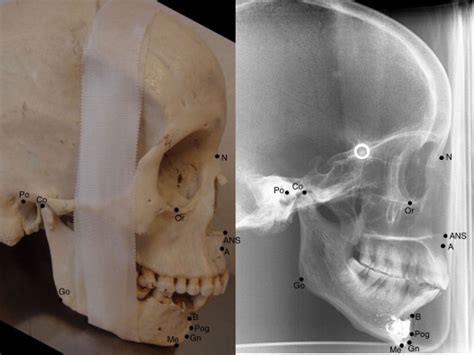 Cephalometric Landmarks Used In The Study N Nasion Me Menton Ans