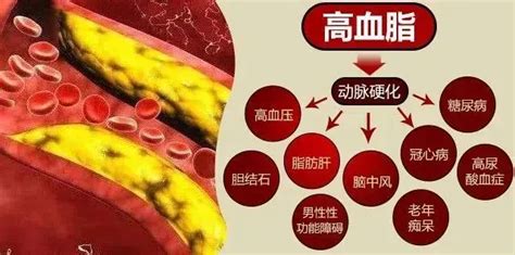 “血脂超高危”人群有你吗？最新血脂管理指南重磅发布！ 知乎