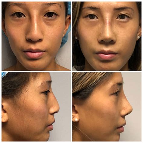 Asian Rhinoplasty Before And After