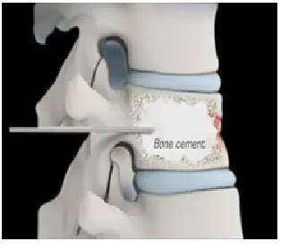 Kyphoplasty Vertebroplasty Bone Cement Lithosmed