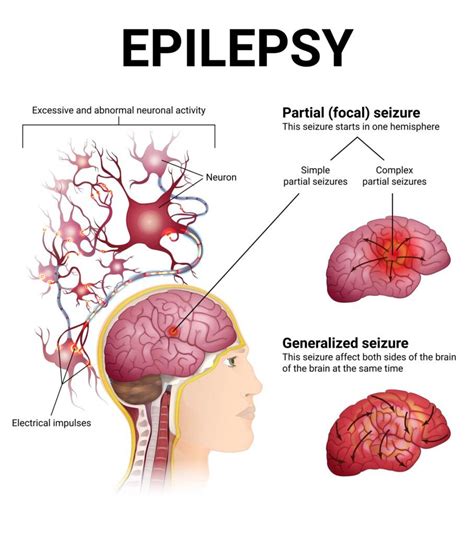 Understanding The Different Types Of Epileptic Seizures And How They