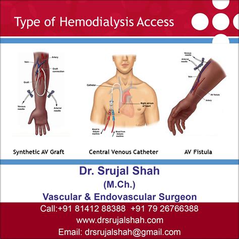Dialysis Fistula Vs Graft