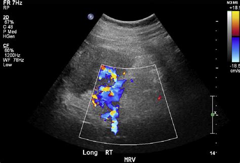 Ultrasound Of Renal Masses Radiologic Clinics