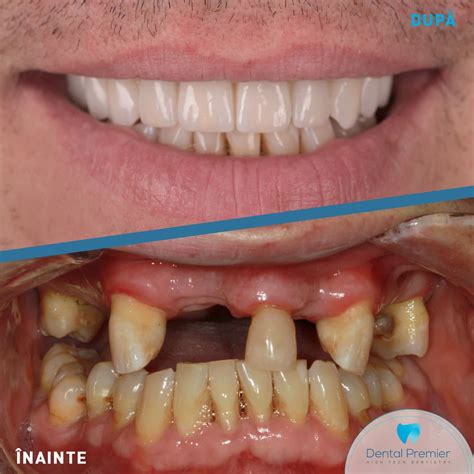 Pacient De Ani Lucrare Proteza Dentara Fixa Pe Implanturi La Maxilar