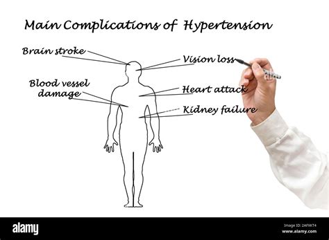 Main Complications Of Hypertension Stock Photo Alamy