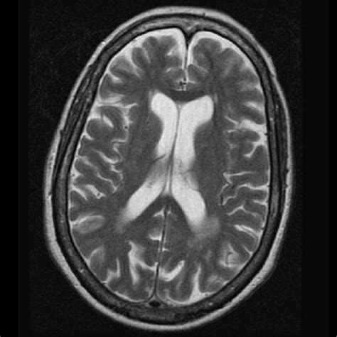 Magnetic Resonance Imaging T2 Hyperintensity Of Brain Showed