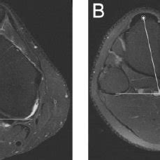 Patellar Tendontrochlear Groove Pt Tg Posterior Condylar Trochlear