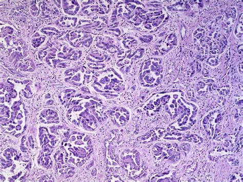 RCC Histology collecting duct - KCCure