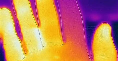 Raynaud S Syndrome Album On Imgur