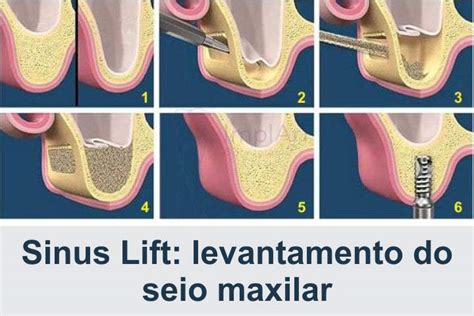 técnica de Summers implante dentário ImplArt