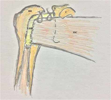 Soft Arthroscopic Latarjet Procedure Technical Note On Biceps Tendon