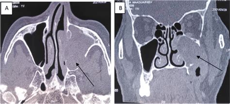 Preoperative axial (A) and coronary(B) CT scan with a tumorous mass in... | Download Scientific ...