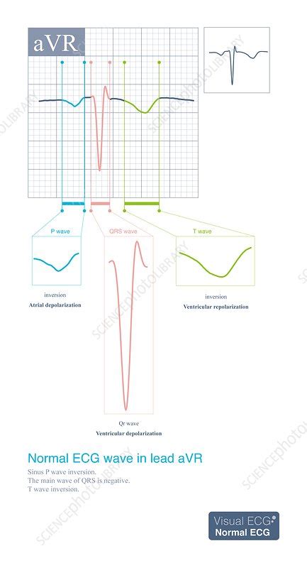 significance  lead avr  acute coronary syndrome