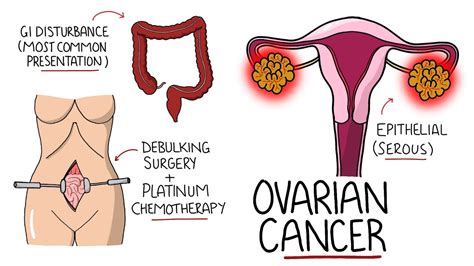 Ovarian Cancer Explained Including Subtypes Youtube