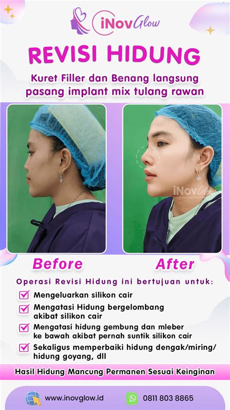 Before After Operasi Hidung Inovglow Klinik Spesialis Bedah Plastik