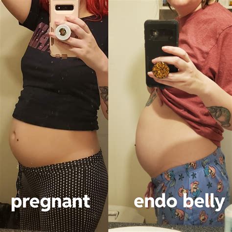 Endo Belly Comparison With 5 Months Pregnant Belly R Endo