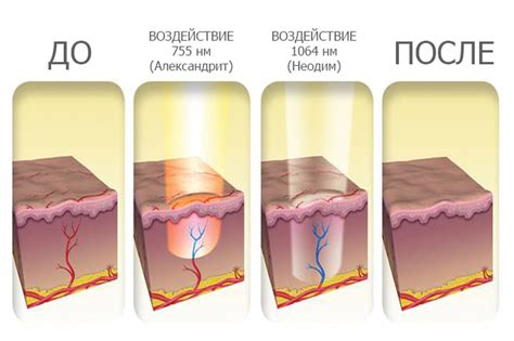 Лазерная эпиляция — Umetex Aesthetics