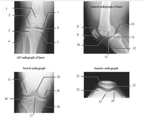 Netter S Concise Orthopaedic Anatomy Chapter 9 Leg Knee Radiology