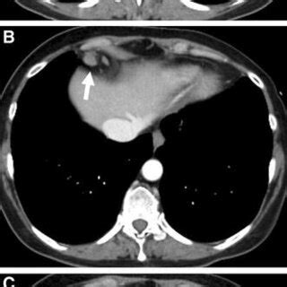 A Axial Contrast Material Enhanced Ct Scan In A Patient With Stage Iii