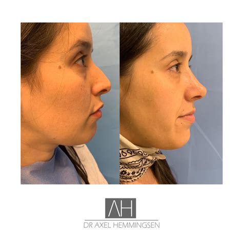 Rinoplastia Precio Argentina Dr Axel Hemmingsen