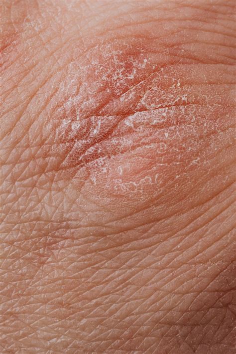 A Guide To Recognizing Morgellons Disease Wrcbtv Chattanooga