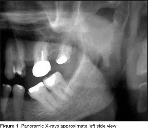 Figure 1 From Primary Auriculotemporal Neuralgia Case Report