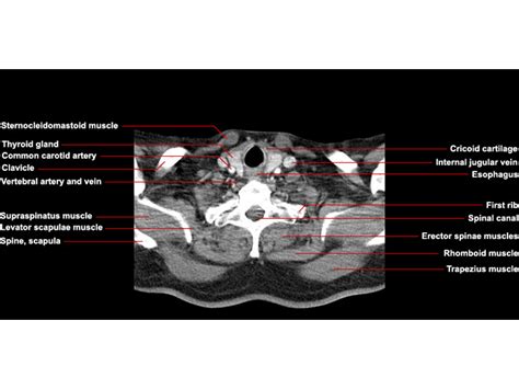 Ct Neck Axial Anatomy Radiologypicscom