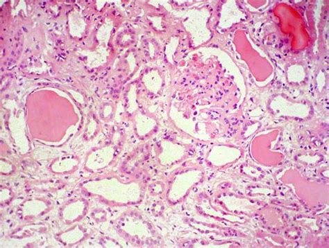 Acute Interstitial Nephritis Renal Medbullets Step 1