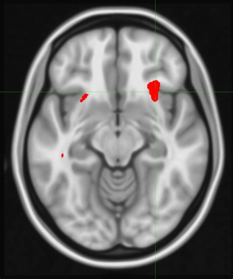 Personalizing Depression Treatment With Brain Scans Nih Directors Blog